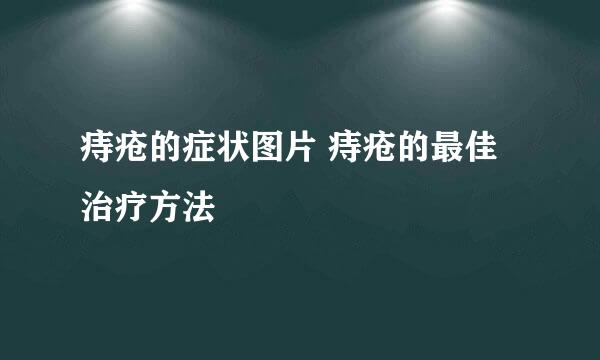 痔疮的症状图片 痔疮的最佳治疗方法